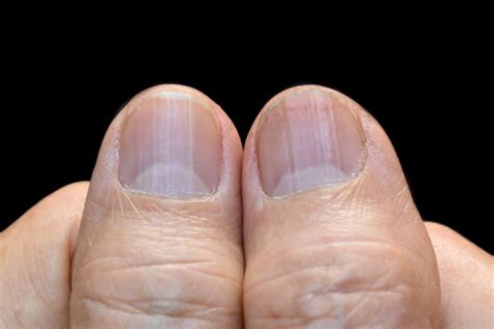 Delve into the Mystery of Vertical Nail Lines: Causes and Implications