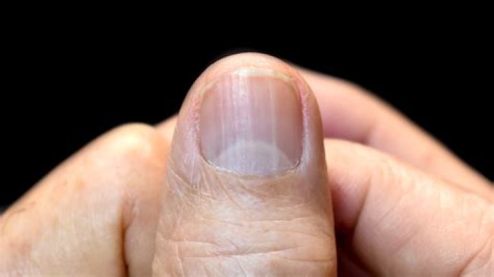 Is Your Fingernail Trying To Tell You Something? Uncover the Causes of Vertical Fingernail Lines
